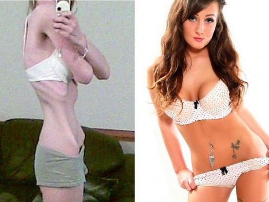 Šokējošs stāsts: meitene nokrītas svarā līdz divdesmit septiņiem kilogramiem