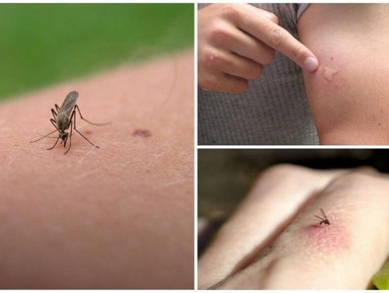 Kā ārstēt odu koduma vietu – divi populāri paņēmieni