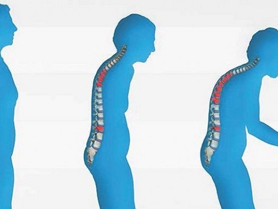 Osteoporoze: Kā mūsu ķermenis kļūst trausls.