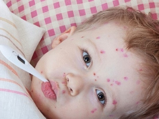 Bērnu slimības:  ko labāk izslimot bērnībā