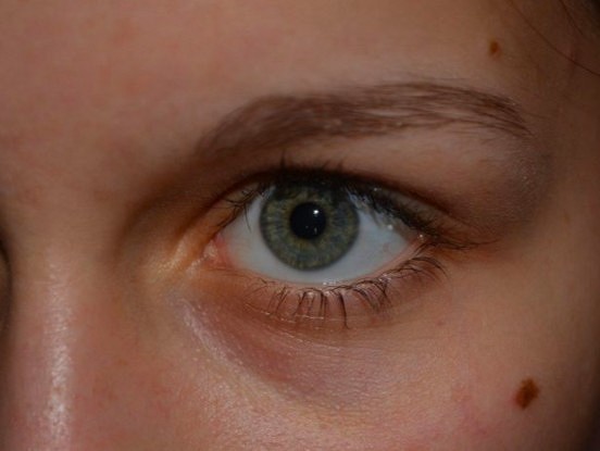 Onkologs stāsta, ko darīt, ja nejauši traumēta dzimumzīme