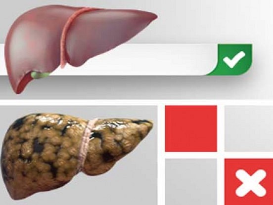 Mājas līdzekļi aknu taukainās hepatozes ārstēšanai